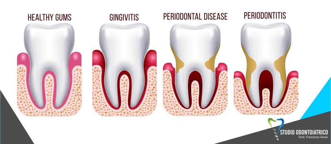 Capire la Parodontite per prevenire la perdita dei denti