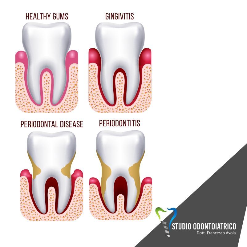 Capire la Parodontite per prevenire la perdita dei denti