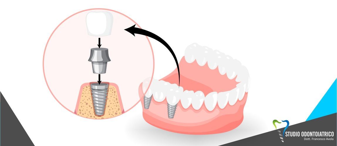 Implantologia a carico immediato