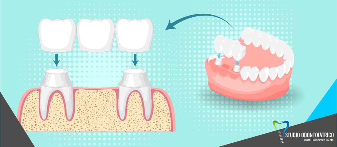 Intarsi e Corone dentali