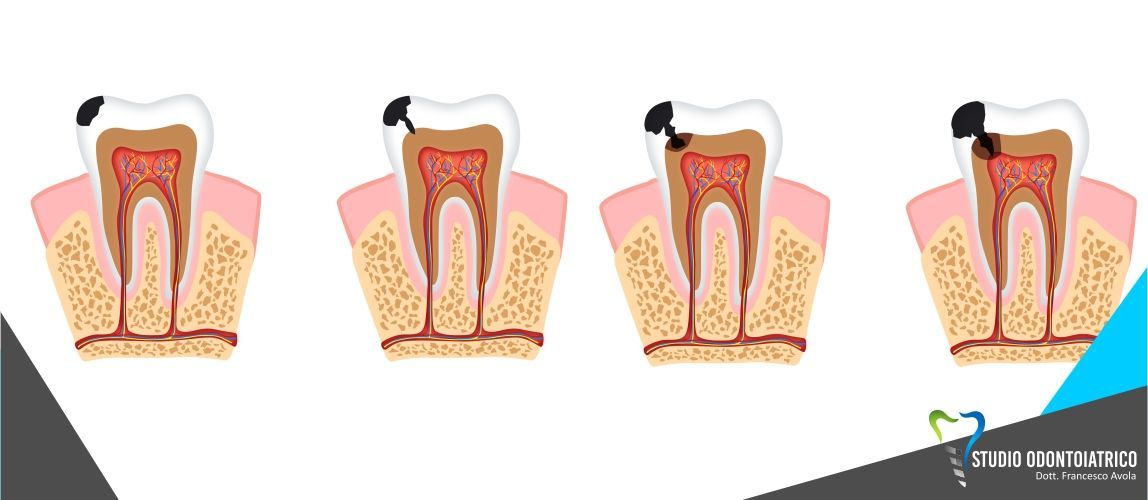 La carie dentale, come prevenirla e come curarla