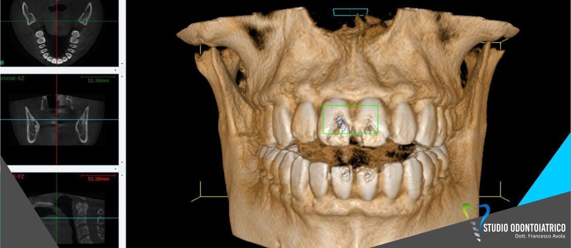 La CBCT (tac) in odontoiatria