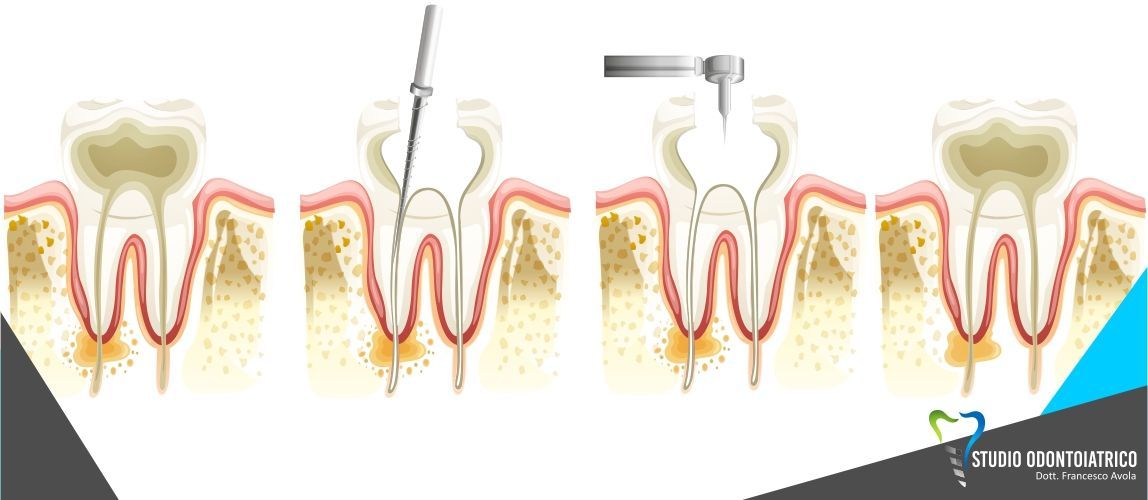 Devitalizzazione dentaria